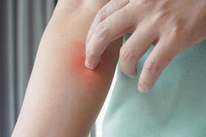 Young asian man itching and scratching on arm from itchy dry skin eczema dermatitis photo