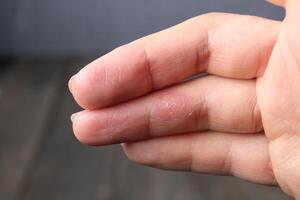 Injured finger. A mark of a healed wound on a finger. Scars photo