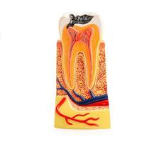 Tooth decay model isolated on white background with clipping path. photo