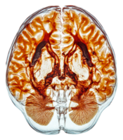 Brain scan showing vascular structure and detail, cut out - stock . png