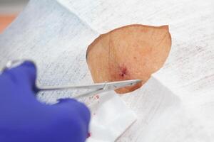 Doctor suturing a patient during a small surgery. Dermatologist carrying out a skin biopsy on the face of a senior adult patient. photo