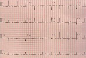 Electrocardiogram in paper form. Analog electrocardiographic recording. ECG example. photo