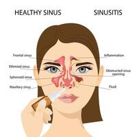 Sinusitis, Female face with inflammation of the mucous membrane of the paranasal vector