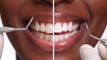 Smiling Person with Radiant White Teeth at Dental Checkup Featuring Before and After Results photo
