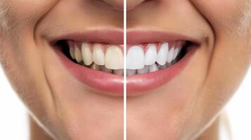 Close-Up of a Smiling Person Showcasing Teeth Whitening with a Radiant and Healthy Smile Concept photo