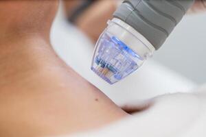 Microneedle RF lifting procedure. close up photo