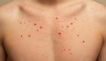Mpox or Monkey pox affected. Red rash on the skin of a young man. photo