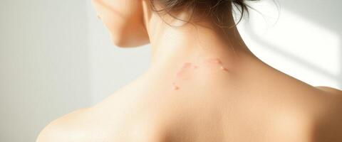 Close Up of Woman's Back with Stretch Marks photo
