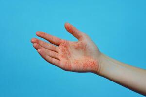 An image that showcases a male hand exhibiting an inflamed rash, which could potentially be caused by a viral infection or an allergic reaction. There is some available space for copy in the image photo