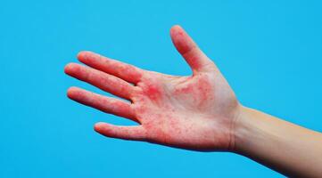 A hand with painful red blisters indicates a possible viral infection or allergic reaction, highlighting significant skin inflammation and prompting a deeper medical discussion about the condition photo