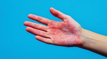 This image clearly depicts a hand that has developed noticeable red blisters, which may indicate possible underlying skin conditions, including various rashes or infections that require attention photo