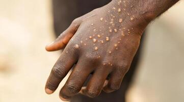 This image shows a monkeypoxinfected hand with spots and lesions, highlighting the need to understand viral diseases and their effects on public health, prevention, and personal care photo