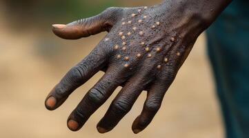 This image provides an upclose view of a human hand showcasing distinct signs of monkeypox virus infection, which is characterized by numerous spots and lesions that are visibly evident on the skin photo