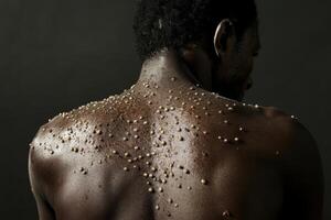This is a comprehensive and detailed view of skin lesions located on an individuals back, with a strong emphasis on showcasing the texture and overall appearance of the rash present photo