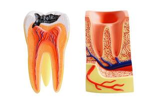 Decay tooth replace with dental implant root canal teeth model for education isolated on white background with clipping path. photo