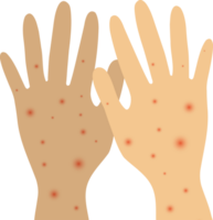 Infected person's hands with Mpox monkeypox virus. Illustration of visible rash and red lesions symptoms of the Monkeypox virus. png