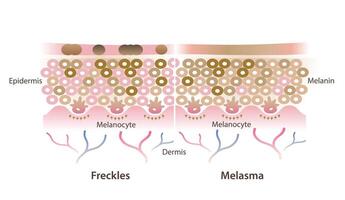 Cross section of freckles and melasma on skin layer illustration isolated on white background. Comparison of freckles are small flat brown spots and melasma is brown, blue gray patches on skin. vector