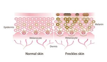 Comparison of normal and freckles skin illustration isolated on white background. Cross section of healthy skin layer and melanocytes make more melanin that develop to small flat brown spots. vector