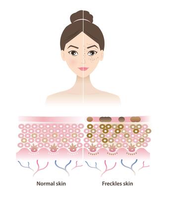 Infographic of normal and freckles skin on woman face illustration. Comparison of healthy epidermis skin layer, hyperpigmentation, small flat dark brown spots. Skin care and beauty concept.