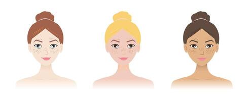 The women with freckles on different skin tone illustration isolated on white background. Ephelides can occur in anyone light skin and have blond or red hair, but anyone can have freckles. vector