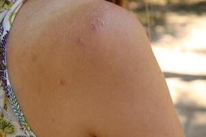 pimple on the forearm. Skin problems on the back and arms. Post-adolescent rashes photo