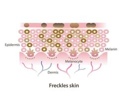 Cross section of freckles on skin layer illustration isolated on white background. Freckles are small flat brown spots on skin, types of hyperpigmentation, ephelides, solar lentigines. vector