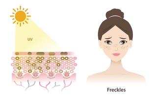 UV rays penetrate into the epidermis skin layer, freckles woman face, result of overproduction of melanin, small flat brown spots illustration isolated on white background. Skin care concept. vector