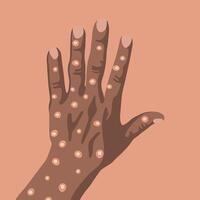 Illustration of a hand of a black man with monkey pox. vector