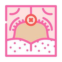 uvulopalatopharyngoplasty surgery color icon illustration vector
