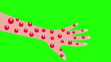 Monkeypox Rashes Popping, Affecting the Hand Animation on Green Background video