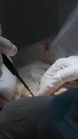 Cardiac surgeon and team perform median sternotomy. Action. Surgeon cauterizing and using professional tool. video