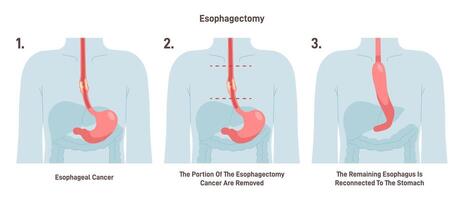 Esophagectomy. Partial excision of the esophagus. Surgical procedure vector