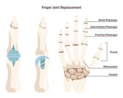 Joint implantation. Injured or distracted human joint replaced with artificial vector