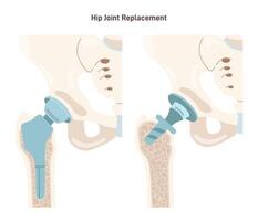 Joint implantation. Injured or distracted human joint replaced with artificial vector