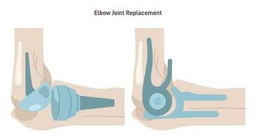 Joint implantation. Injured or distracted human joint replaced with artificial vector