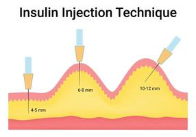 Insulin Injection Technique Science Design Illustration Diagram vector