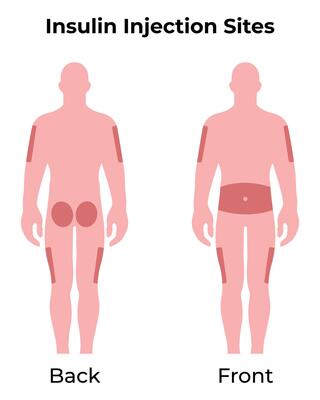 Insulin Injection Sites Science Design Illustration Diagram