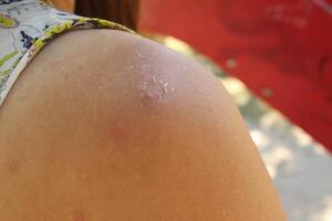 pimple on the forearm. Pimples comedones on shoulder forearm girl close-up photo