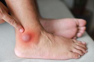 A man injured his ankle and it was swollen and red. Causes of pain include Ankle sprain, Gout, Rheumatoid arthritis, office syndrome, numbness, and cramp symptoms. Healthcare medical concept. photo