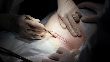 Close-up of a cesarean section in a modern hospital. The image captures the surgical procedure with precise details, highlighting the advanced medical environment and careful attention to the delivery video