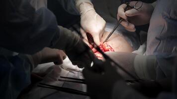 Close-up of a cesarean section in a modern hospital. The image captures the surgical procedure with precise details, highlighting the advanced medical environment and careful attention to the delivery video