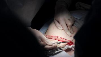 Close-up of a cesarean section in a modern hospital. The image captures the surgical procedure with precise details, highlighting the advanced medical environment and careful attention to the delivery video