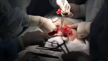 Close-up of a cesarean section in a modern hospital. The image captures the surgical procedure with precise details, highlighting the advanced medical environment and careful attention to the delivery video