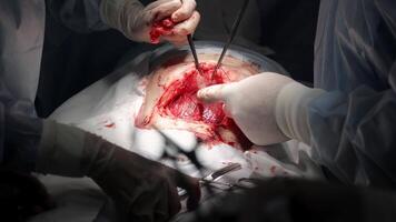 Close-up of a cesarean section in a modern hospital. The image captures the surgical procedure with precise details, highlighting the advanced medical environment and careful attention to the delivery video