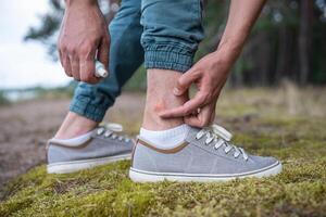 Unrecognizable man hands apply balm to insect bites on ankle. Protect skin from eczema and allergy photo