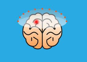 Illustration of focused ultrasound treatment targeting a specific region of the brain, representing a non-invasive therapy for neurological diseases. vector