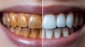 A close up of a person's teeth, with one side being yellow and the other side being white. The contrast between the two teeth highlights the importance of proper dental hygiene photo