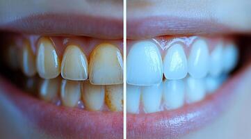Two different sets of teeth, one with a yellowish tint and the other with a white color. The teeth with the yellowish tint are likely in need of a professional cleaning photo