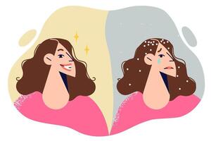 Dandruff appeared in woman hair due to problems with immune system or use of bad shampoo vector