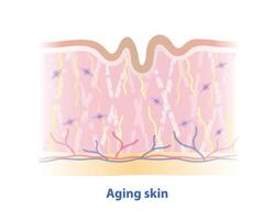 Broken collagen, elastin fibers and reduced fibroblasts size with aging skin layer illustration isolated on white background. Formation of wrinkled skin, lose strength, flexibility, firmness. vector